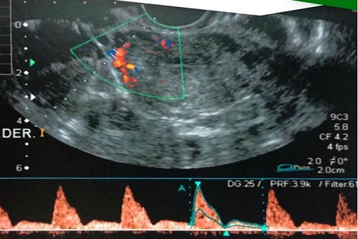 Qu Es La Ecograf A Doppler Serofca