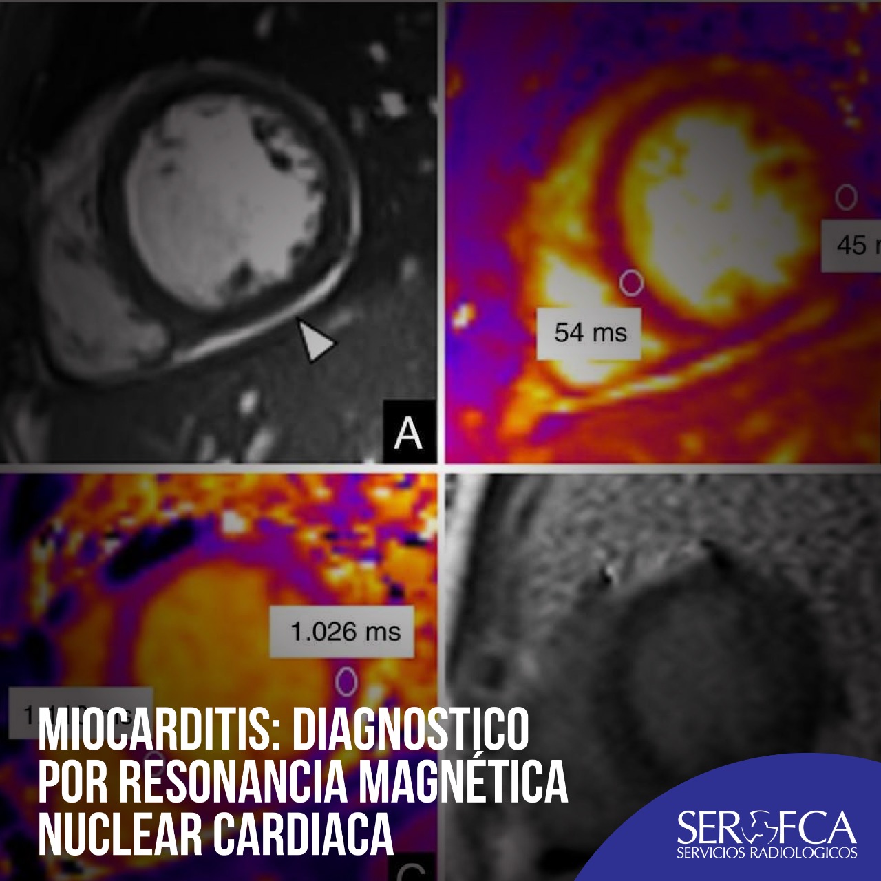 Miocarditis Diagnóstico Por Resonancia Magnética Nuclear Cardíaca Serofca 4203